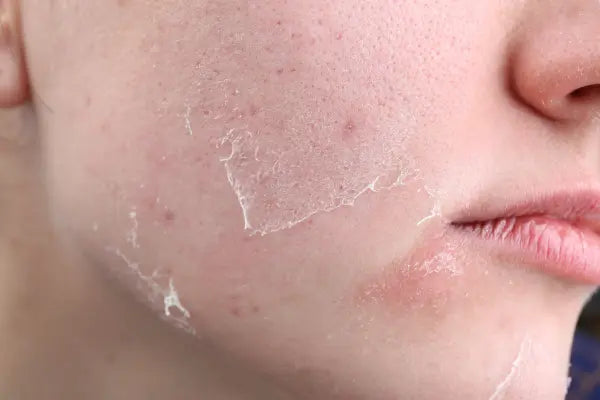 Dry skin in winter? How to save your skin from the cold
