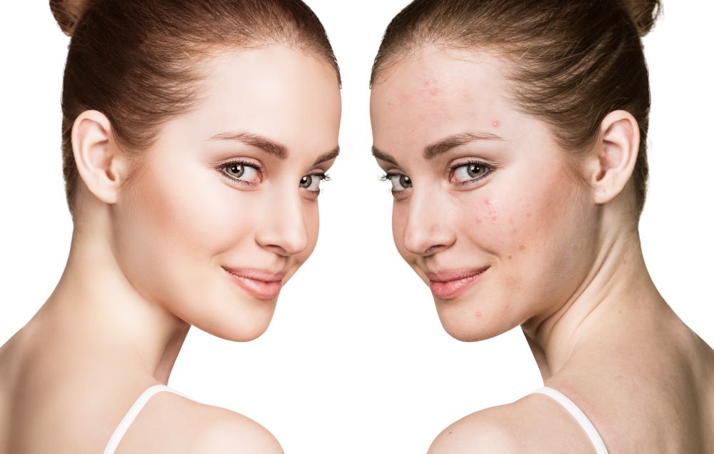 What helps against pimples on the face?
