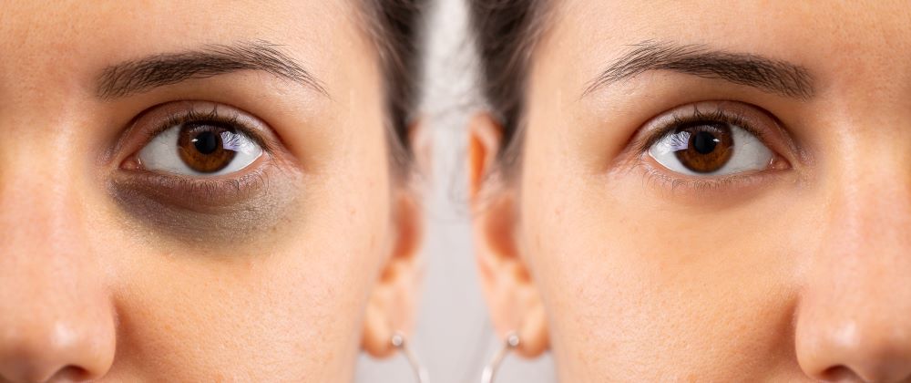 What helps against dark circles