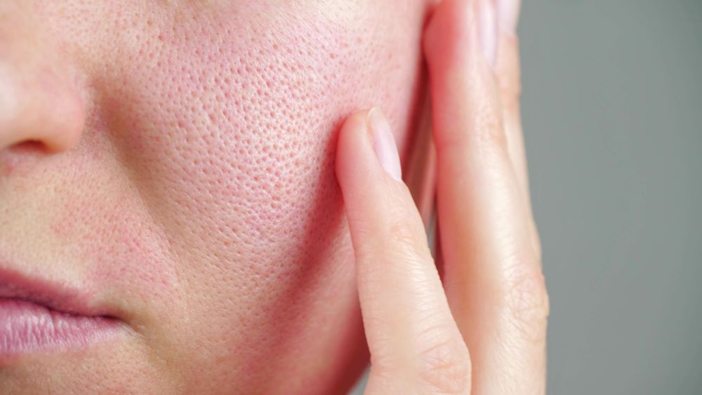 What helps against large pores on the face?