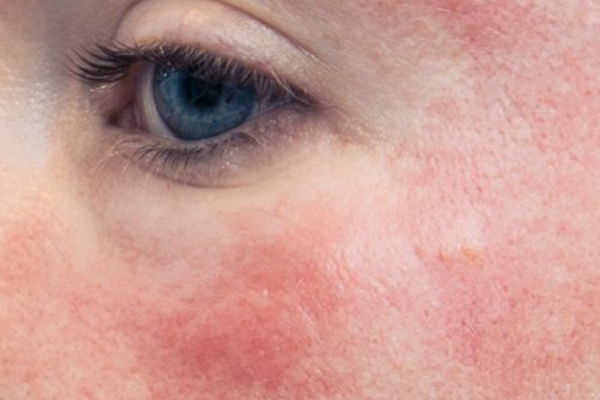 Sensitive skin care: tips and products for a gentle routine