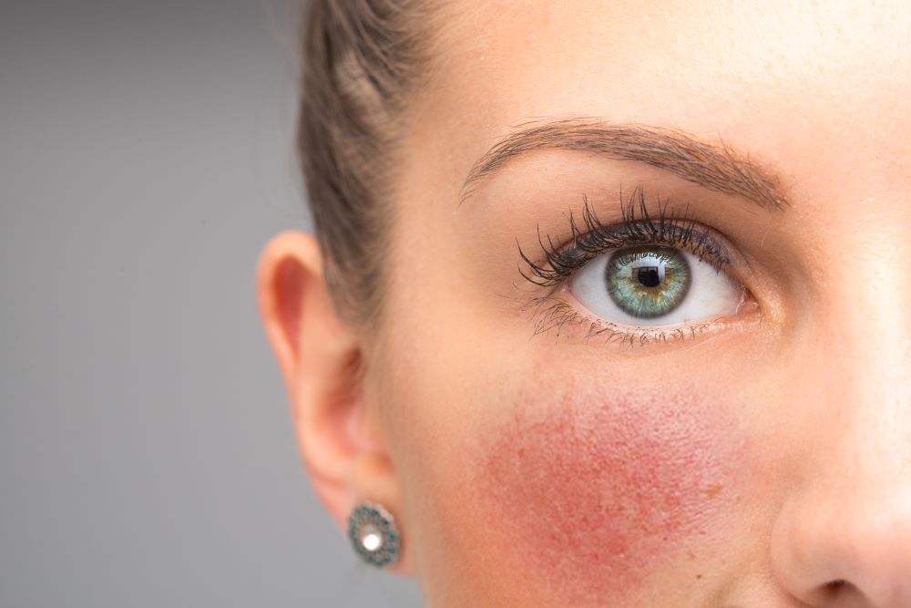 Was tun bei Rosacea?