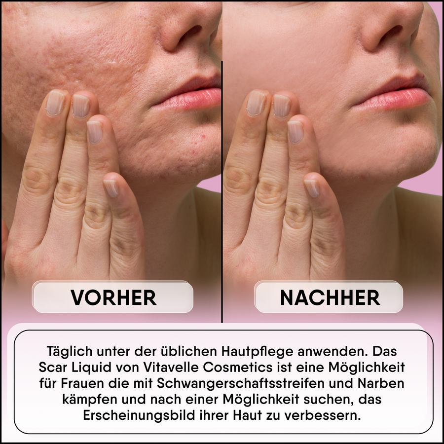 Littekenvloeistof Serum