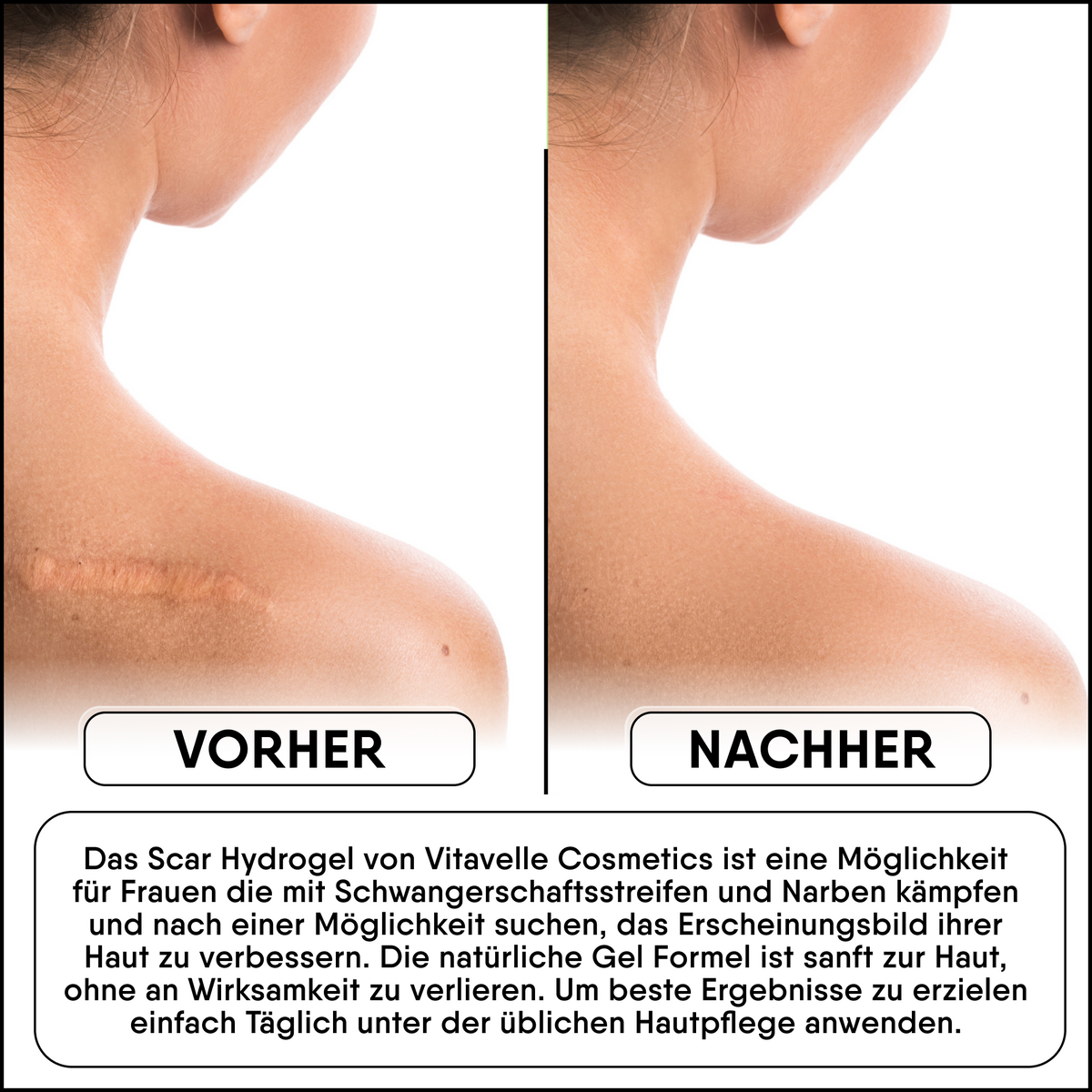 Litteken Hydrogel
